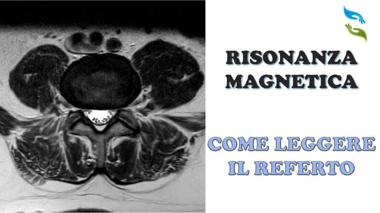 Referto della risonanza magnetica: rilevare precocemente la sclerosi multipla